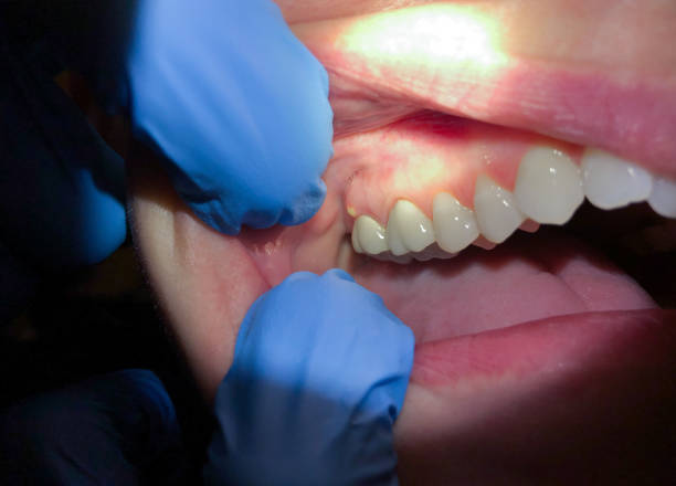 Best Emergency Dental Care for Broken or Chipped Teeth in Seabrook, MD