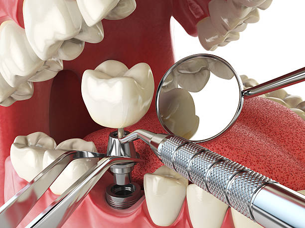Best Emergency Wisdom Teeth Removal in Seabrook, MD